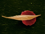 Glóbulo rojo típico de la anemia falciforme con uno normal al fondo