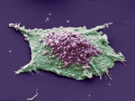 Celula hepática cancerosa
